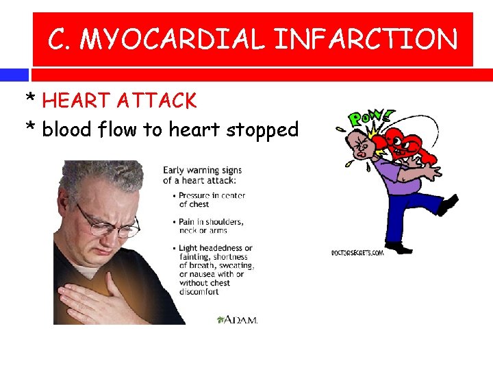 C. MYOCARDIAL INFARCTION * HEART ATTACK * blood flow to heart stopped 