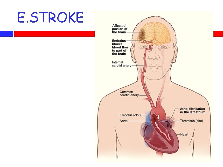 E. STROKE 