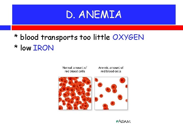 D. ANEMIA * blood transports too little OXYGEN * low IRON 