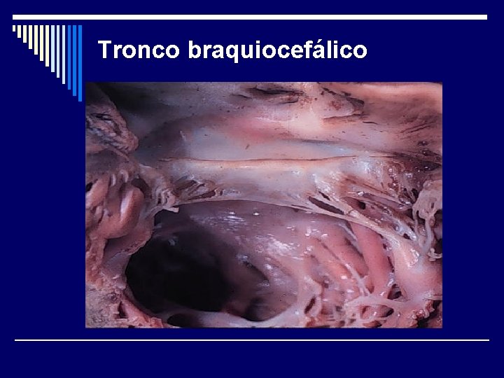 Tronco braquiocefálico 