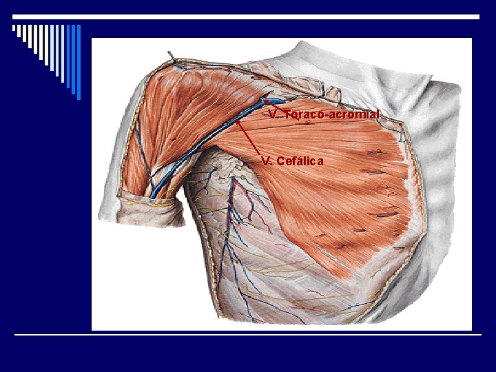 V. Toraco-acromial V. Cefálica 