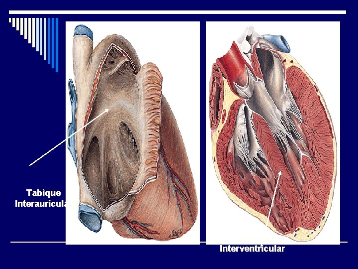 Tabique Interauricular Tabique Interventricular 