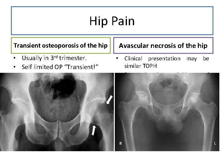 Hip Pain Transient osteoporosis of the hip Usually in 3 rd trimester. Self limited
