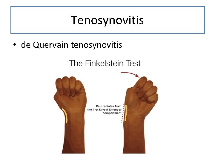 Tenosynovitis • de Quervain tenosynovitis 