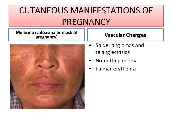 CUTANEOUS MANIFESTATIONS OF PREGNANCY Melasma (chloasma or mask of pregnancy) Vascular Changes • Spider