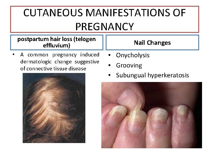 CUTANEOUS MANIFESTATIONS OF PREGNANCY postpartum hair loss (telogen effluvium) • A common pregnancy induced