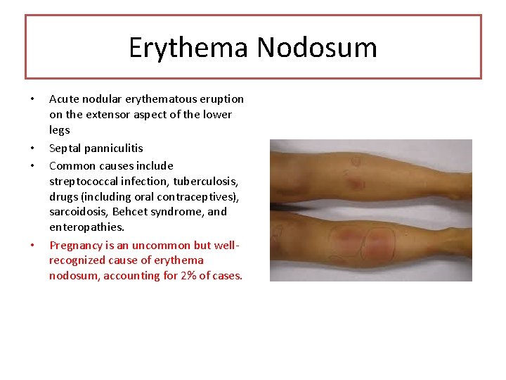 Erythema Nodosum • • Acute nodular erythematous eruption on the extensor aspect of the