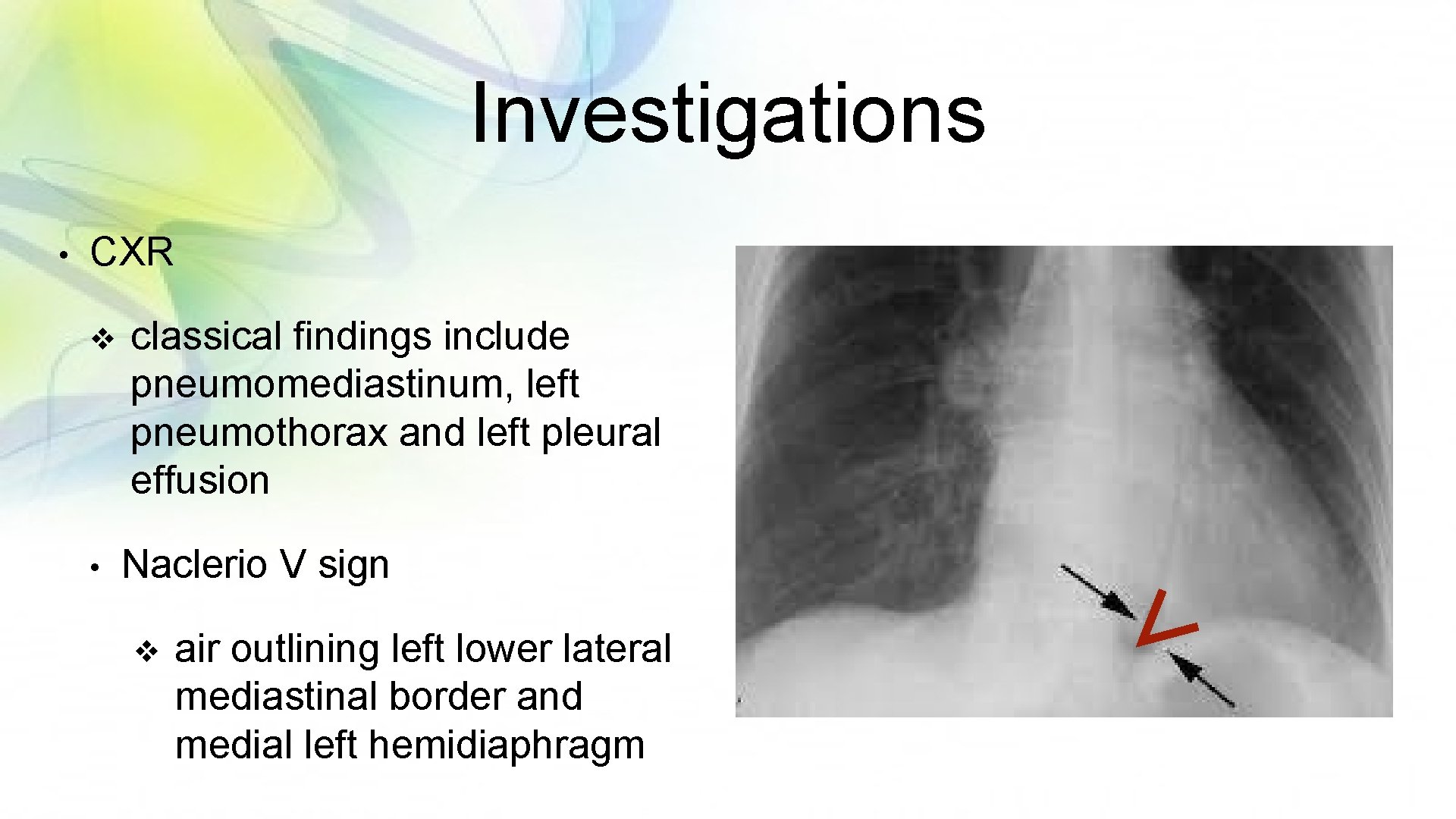 Investigations • CXR v • classical findings include pneumomediastinum, left pneumothorax and left pleural