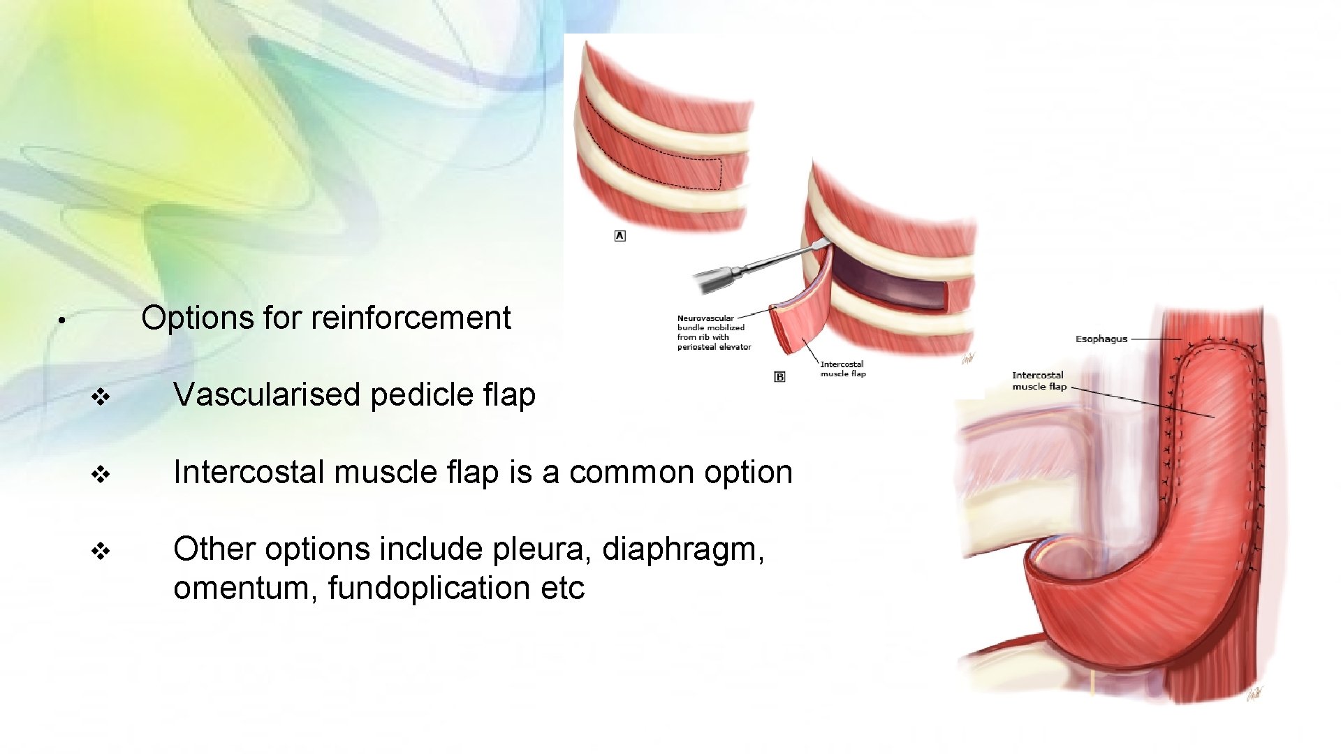 Options for reinforcement • v Vascularised pedicle flap v Intercostal muscle flap is a