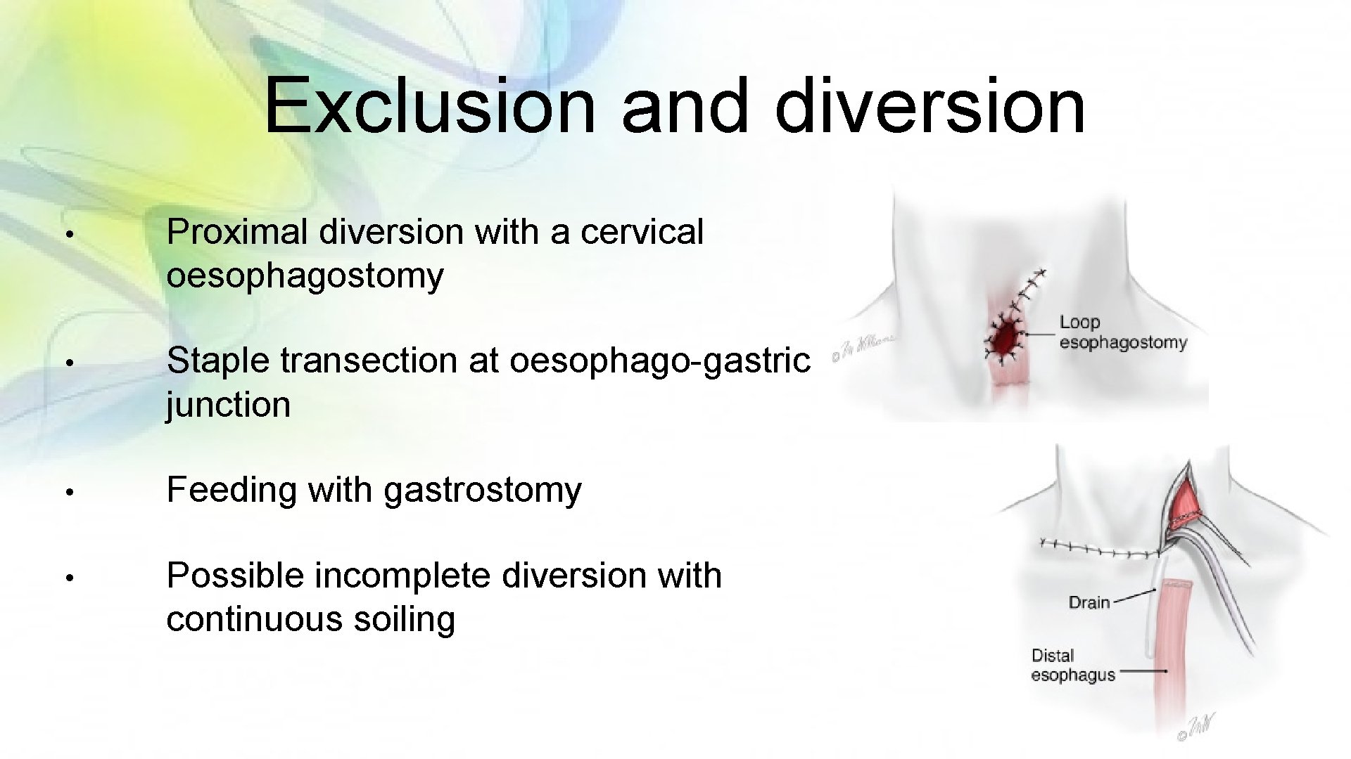 Exclusion and diversion • Proximal diversion with a cervical oesophagostomy • Staple transection at