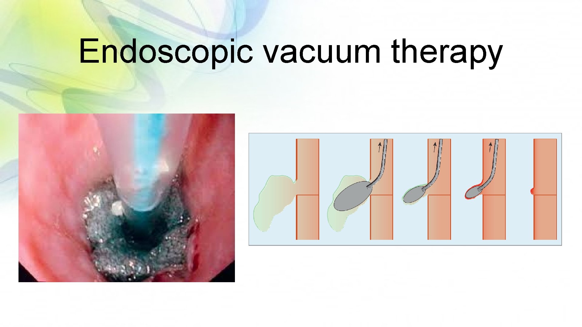 Endoscopic vacuum therapy 