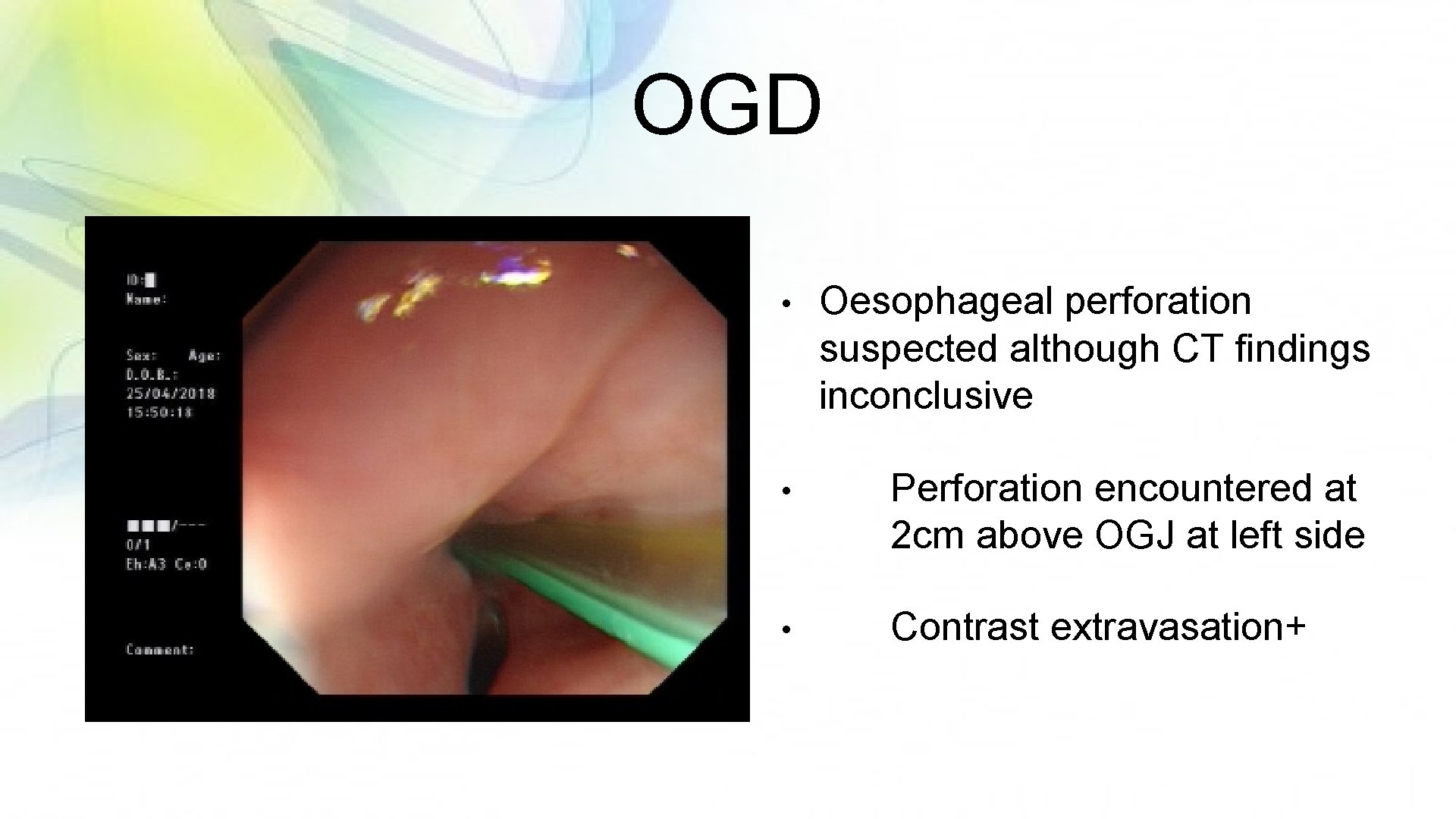 OGD • Oesophageal perforation suspected although CT findings inconclusive • Perforation encountered at 2