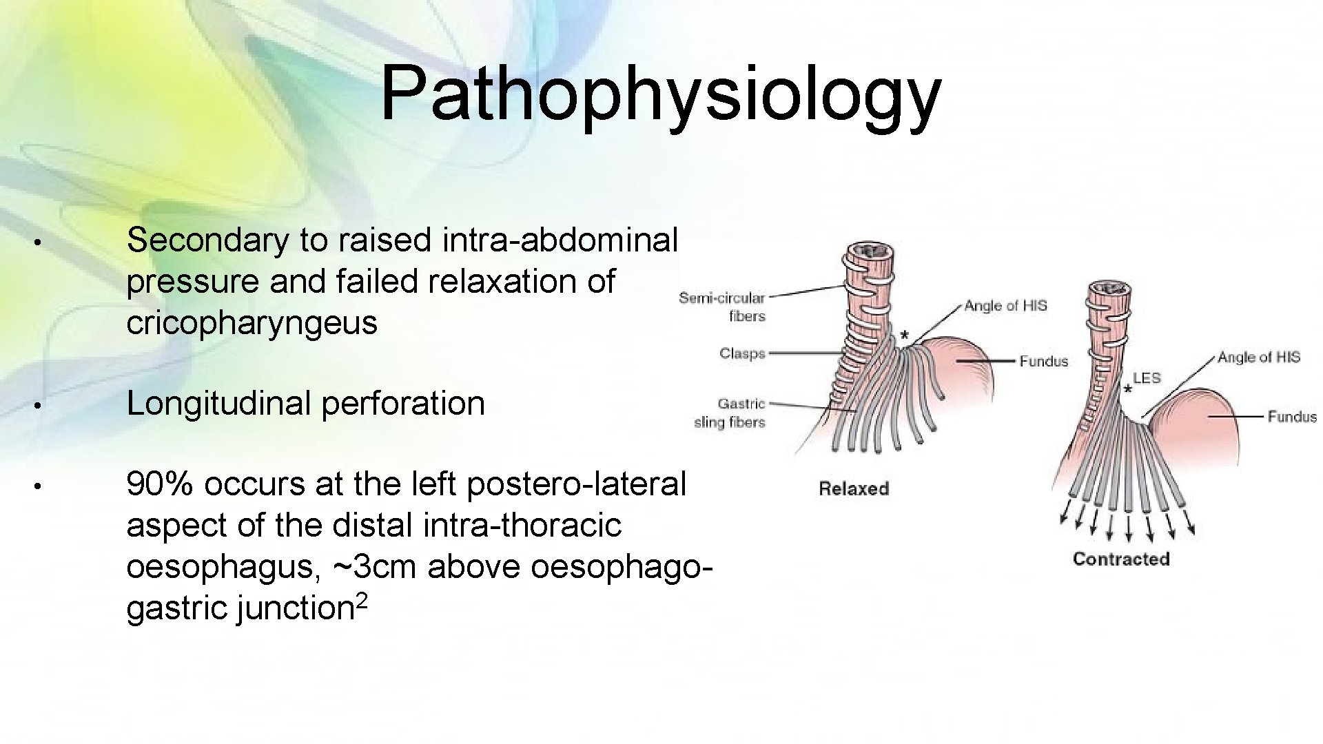 Pathophysiology • Secondary to raised intra-abdominal pressure and failed relaxation of cricopharyngeus • Longitudinal