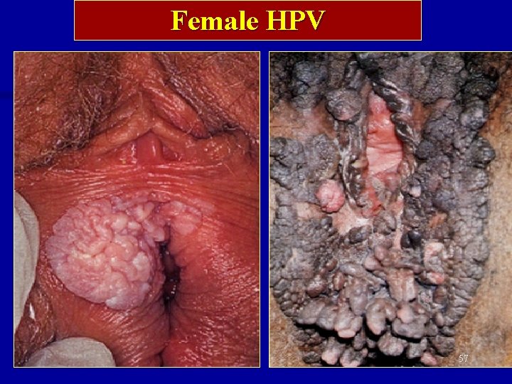 Female HPV 57 