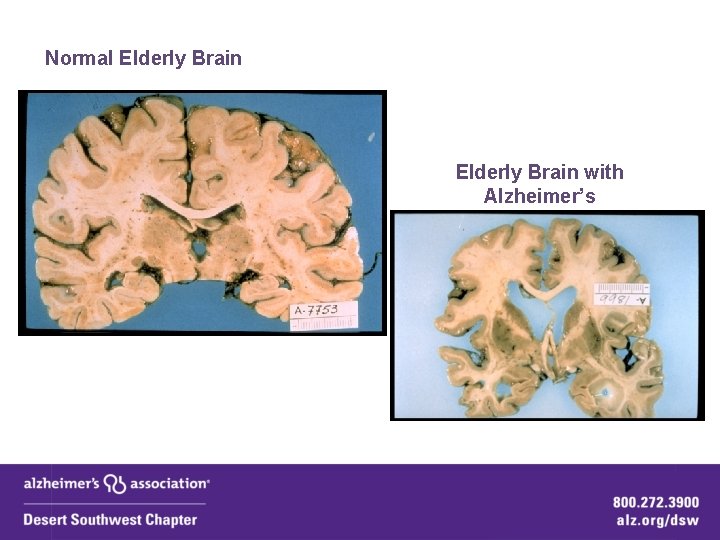 Normal Elderly Brain with Alzheimer’s Normal Elderly Brain with Alzheimer’s