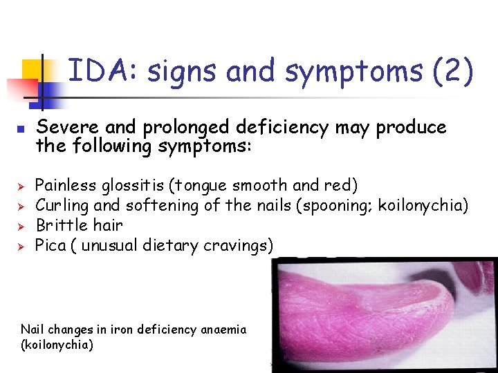 IDA: signs and symptoms (2) n Ø Ø Severe and prolonged deficiency may produce