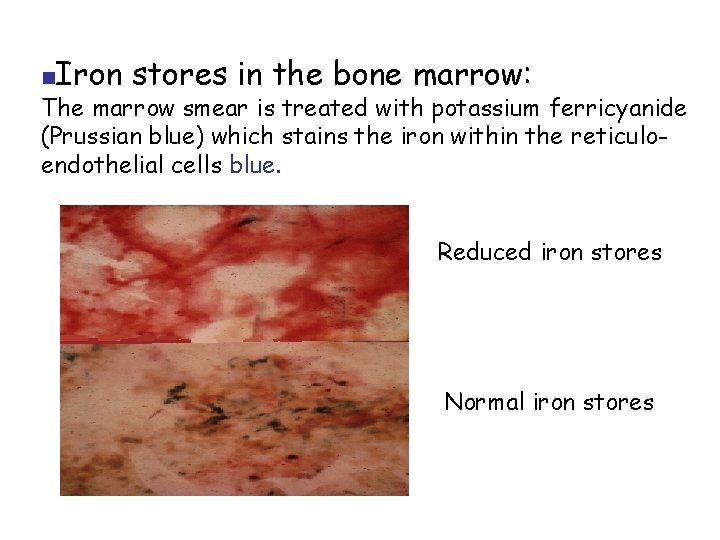 n Iron stores in the bone marrow: The marrow smear is treated with potassium