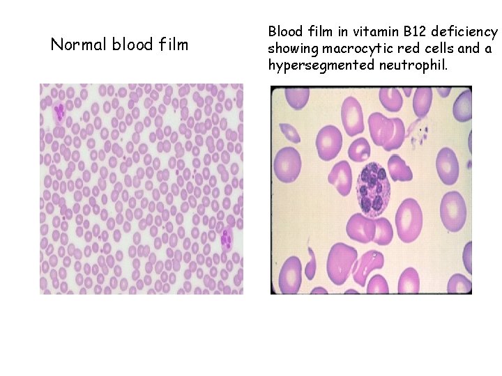 Normal blood film Blood film in vitamin B 12 deficiency showing macrocytic red cells