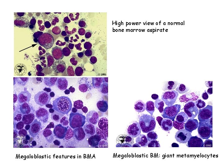 High power view of a normal bone marrow aspirate Megaloblastic features in BMA Megaloblastic