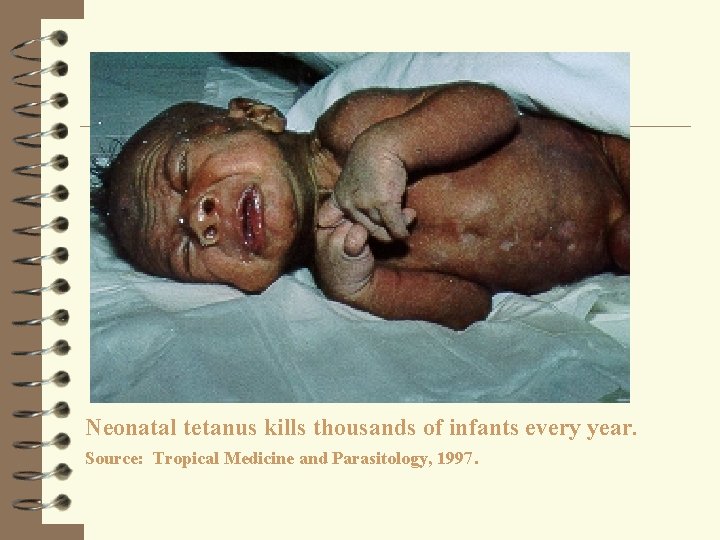 Neonatal tetanus kills thousands of infants every year. Source: Tropical Medicine and Parasitology, 1997.