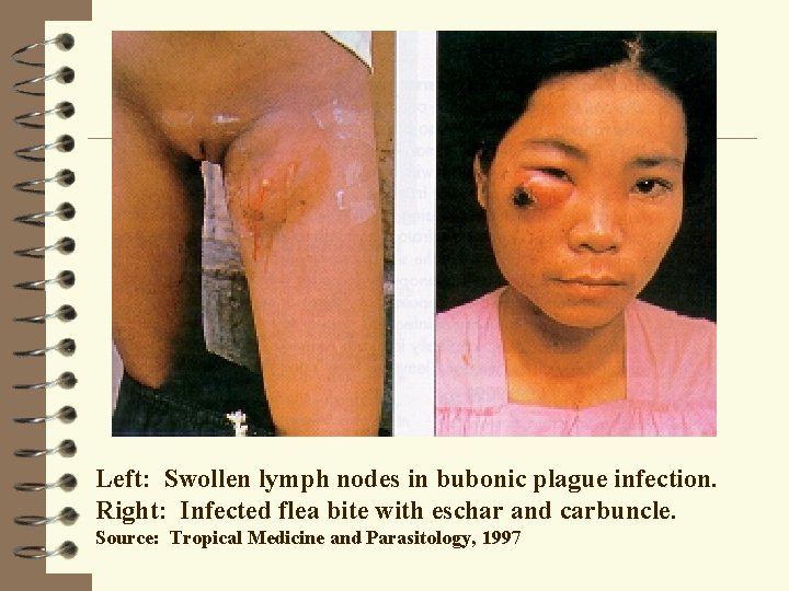 Left: Swollen lymph nodes in bubonic plague infection. Right: Infected flea bite with eschar