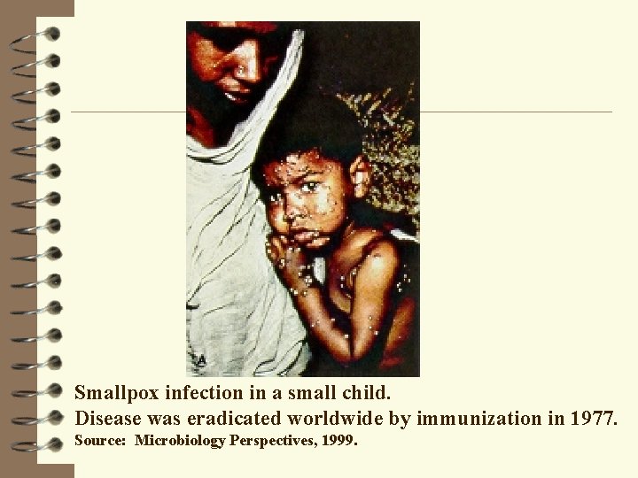 Smallpox infection in a small child. Disease was eradicated worldwide by immunization in 1977.