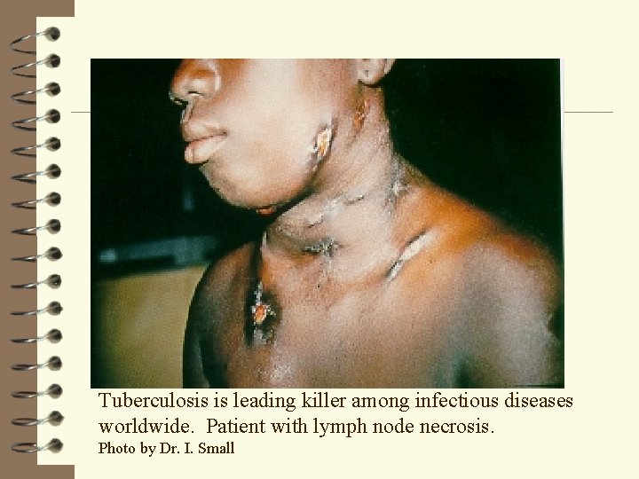 Tuberculosis is leading killer among infectious diseases worldwide. Patient with lymph node necrosis. Photo