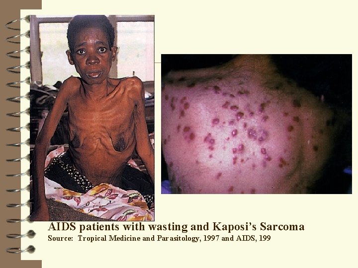 AIDS patients with wasting and Kaposi’s Sarcoma Source: Tropical Medicine and Parasitology, 1997 and