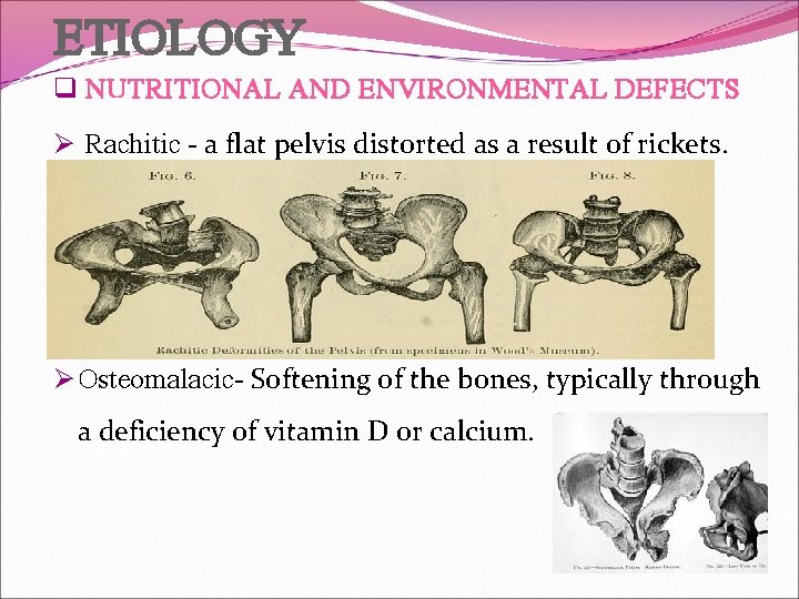 ETIOLOGY q NUTRITIONAL AND ENVIRONMENTAL DEFECTS Ø Rachitic - a flat pelvis distorted as