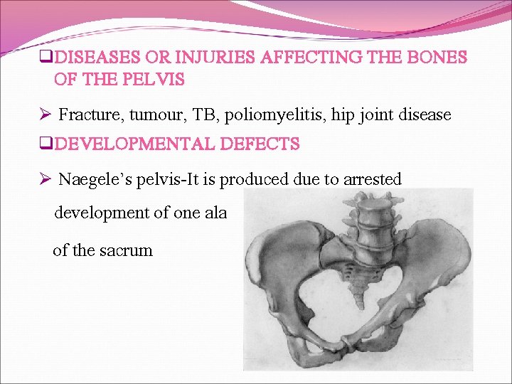 q. DISEASES OR INJURIES AFFECTING THE BONES OF THE PELVIS Ø Fracture, tumour, TB,