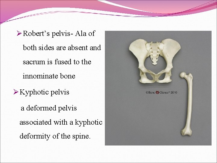 Ø Robert’s pelvis- Ala of both sides are absent and sacrum is fused to