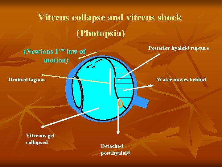 Vitreus collapse and vitreus shock (Photopsia) Posterior hyaloid rupture (Newtons 1 rst law of