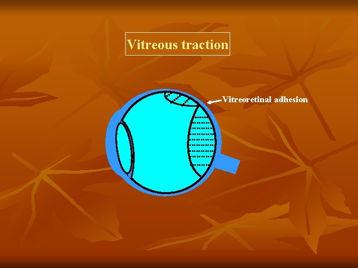Vitreous traction Vitreoretinal adhesion 