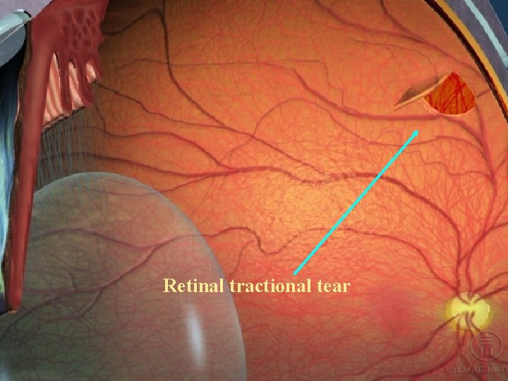 Retinal tractional tear 