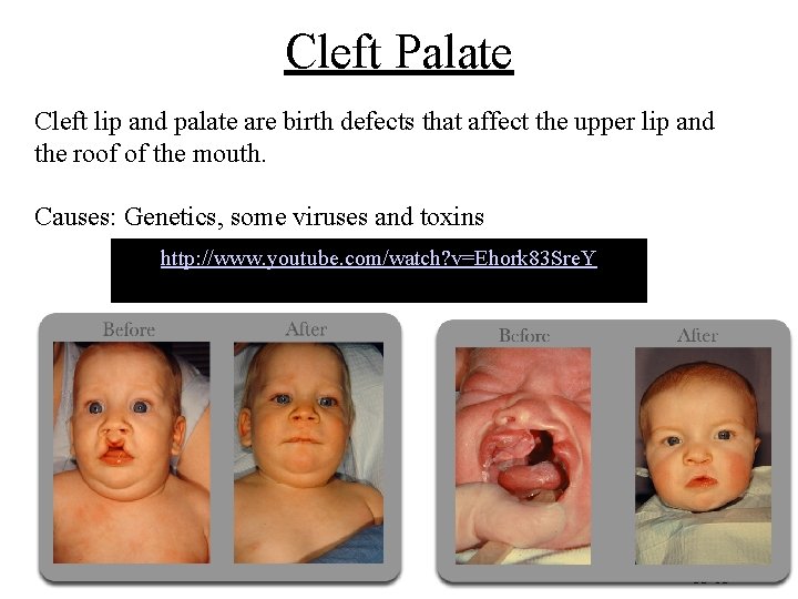 Cleft Palate Cleft lip and palate are birth defects that affect the upper lip