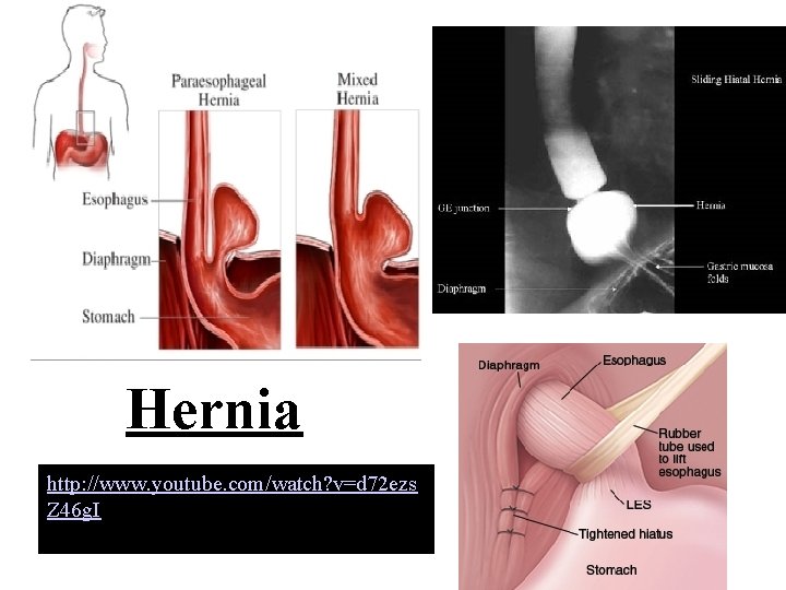 Hernia http: //www. youtube. com/watch? v=d 72 ezs Z 46 g. I 25 -16