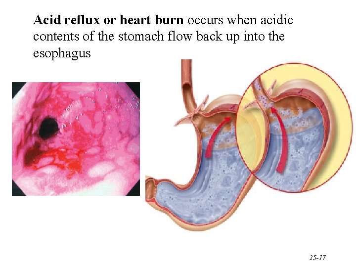 Acid reflux or heart burn occurs when acidic contents of the stomach flow back
