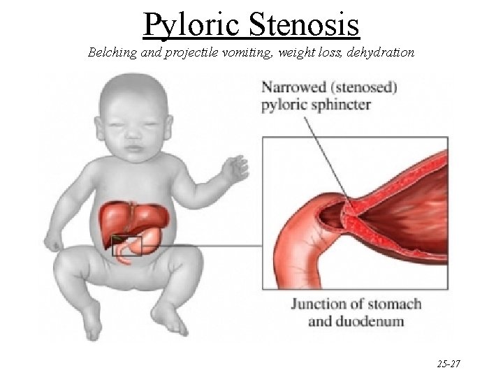 Pyloric Stenosis Belching and projectile vomiting, weight loss, dehydration 25 -27 