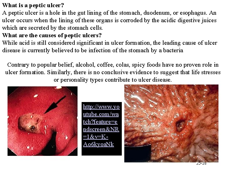 What is a peptic ulcer? A peptic ulcer is a hole in the gut