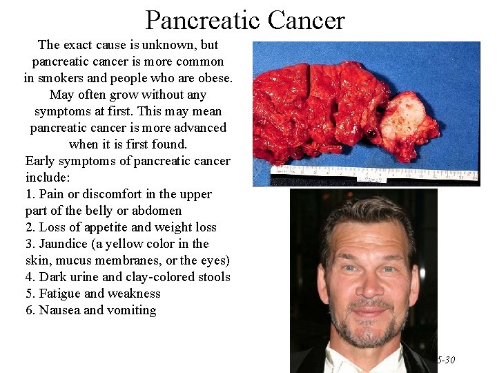 Pancreatic Cancer The exact cause is unknown, but pancreatic cancer is more common in