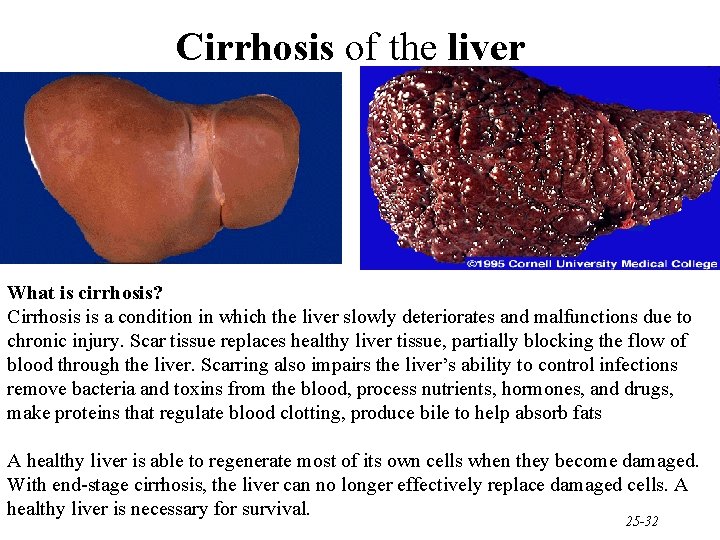 Cirrhosis of the liver What is cirrhosis? Cirrhosis is a condition in which the