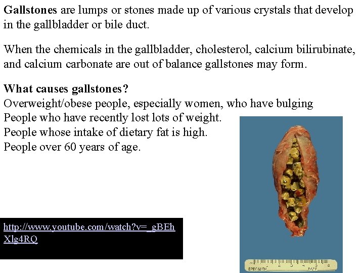 Gallstones are lumps or stones made up of various crystals that develop in the