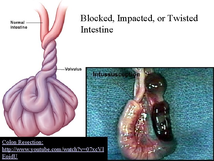 Blocked, Impacted, or Twisted Intestine Colon Resection: http: //www. youtube. com/watch? v=07 xc. Vl