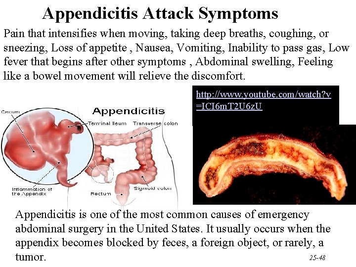 Appendicitis Attack Symptoms Pain that intensifies when moving, taking deep breaths, coughing, or sneezing,