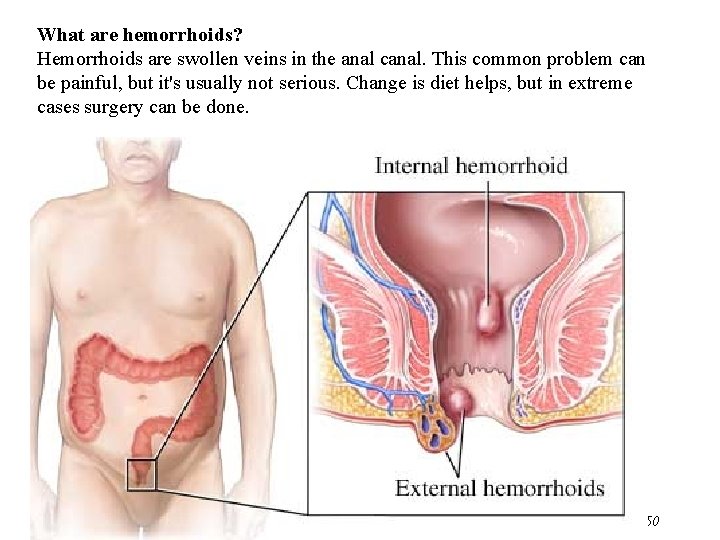 What are hemorrhoids? Hemorrhoids are swollen veins in the anal canal. This common problem