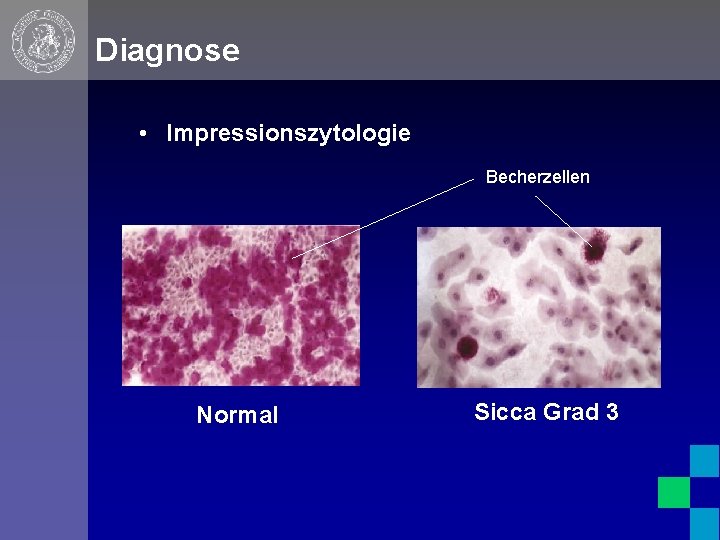 Diagnose • Impressionszytologie Becherzellen Normal Sicca Grad 3 