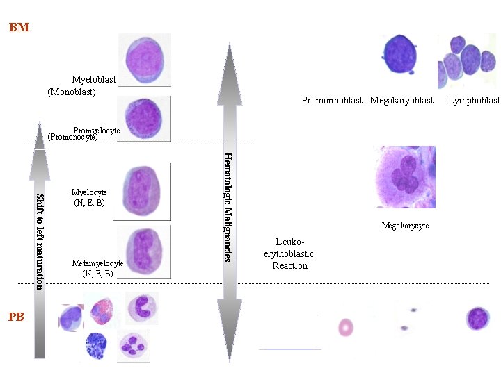 BM Myeloblast (Monoblast) Promormoblast Megakaryoblast Promyelocyte (Promonocyte) Metamyelocyte (N, E, B) Hematologic Malignancies Shift