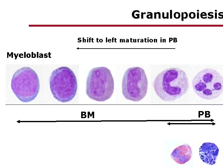 Granulopoiesis Shift to left maturation in PB Myeloblast BM PB 