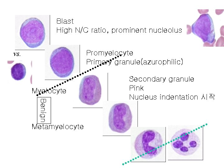 Blast High N/C ratio, prominent nucleolus Promyelocyte Primary granule(azurophilic) vs. Myelocyte Benign Metamyelocyte Secondary