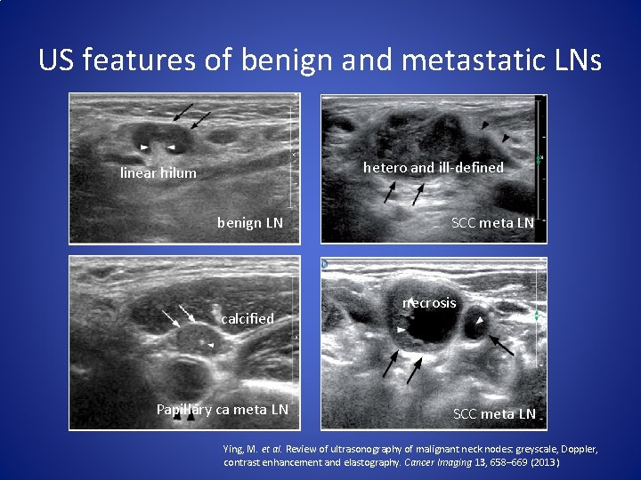 US features of benign and metastatic LNs hetero and ill-defined linear hilum benign LN